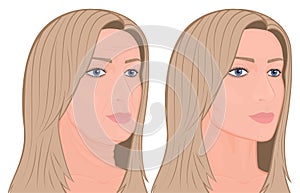 Plastic surgery_Face lifting