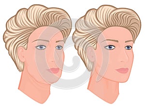 Plastic surgery_Facial rejuvenation