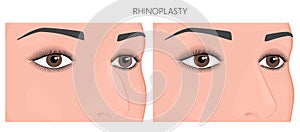 Plastic surgery_Nose job or rhinoplasty