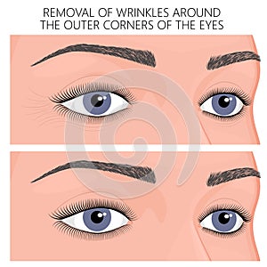 Plastic surgery_Removal of wrinkles around the outer corners of