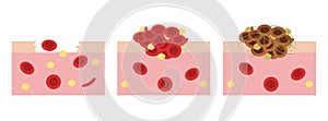 Platelet and fibrin on wound