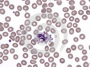 Platelet phagocytosis by neutrophils.