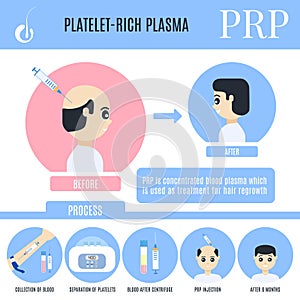 Platelet-rich plasma infographics for male alopecia treatment