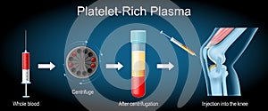 Platelet-rich plasma procedure. knee joint treatment photo