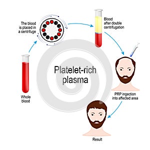 Platelet-rich plasma. PRP Hair Therapy. Medical procedure