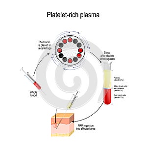 Platelet-rich plasma. PRP is a Medical procedure for Hair growth stimulation photo