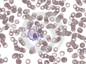 Platelet satellitism. Peripheral blood. photo