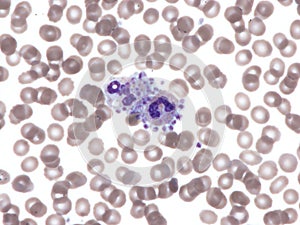 Platelet satellitism. Peripheral blood. photo