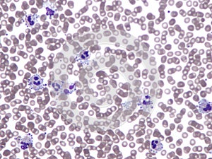 Platelet satellitism. Peripheral blood. photo