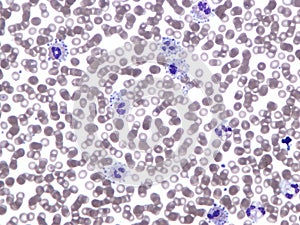 Platelet satellitism. Peripheral blood. photo