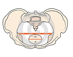 Platypoid or Platypelloid Pelvis Shape w Round or Circular shape