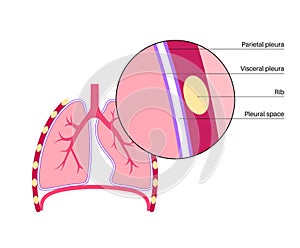 Pleura anatomical poster