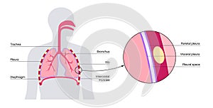 Pleura anatomical poster