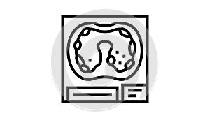 pleural asbestosis disease line icon animation