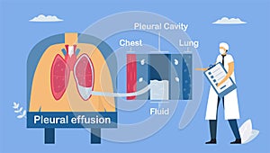 Pleural effusion is collection of excess fluid between layers of pleura outside lungs. Pulmonology vector illustration about
