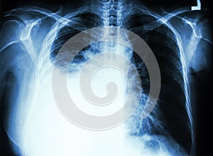 Pleural effusion due to lung cancer photo