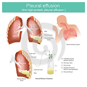 Pleural effusion the high-protein pleural effusion. photo