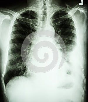 Pleural effusion at left lung due to lung cancer photo