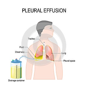 Pleural effusion. Treatment of tension hydrothorax