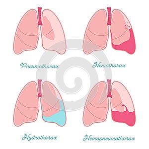 Pleural effusions of human lung. Fluid or air in pleural cavity - vector anatomical scheme. Comparison some types photo