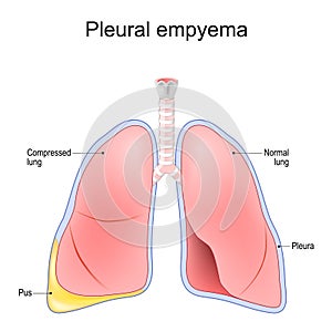 Pleural empyema. Normal lung and lungs after accumulation of pus photo