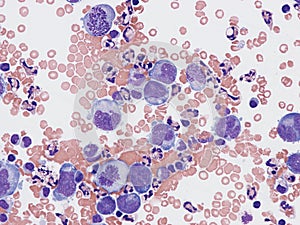 B-cell lymphoma in pleural fluid photo
