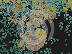 Pleural lymphoma, Cytology.