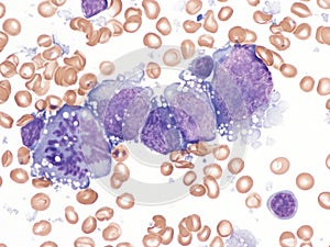 Pleural lymphoma, Cytology.
