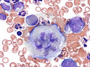 Pleural lymphoma, Cytology. photo