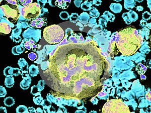 Pleural lymphoma, Cytology. photo