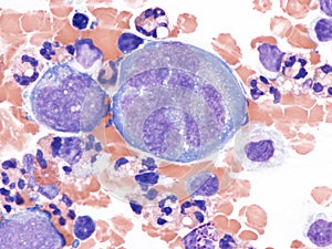 Pleural lymphoma, Cytology. photo