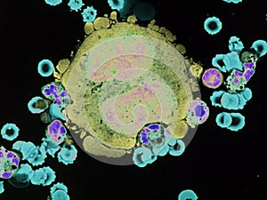 Pleural lymphoma, Cytology. photo