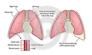 Pleural membranes and fluid