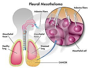 Pleural mesothelioma photo