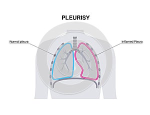 Pleurisy inflammation diseases