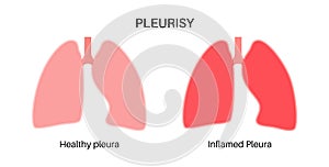 Pleurisy inflammation diseases