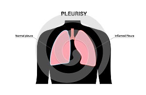 Pleurisy inflammation diseases