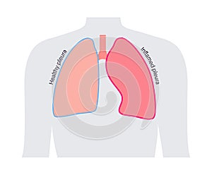 Pleurisy inflammation diseases