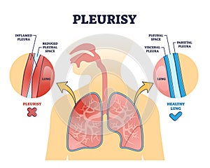 Pleurisy or pleuritis disease as medical lung inflammation outline diagram