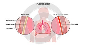 Pleurodesis medical procedure