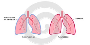 Pleurodesis medical procedure