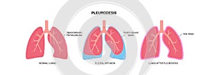 Pleurodesis medical procedure