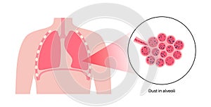 Pneumoconiosis lung disease