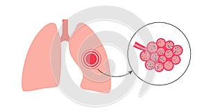 Pneumoconiosis lung disease