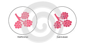 Pneumoconiosis lung disease