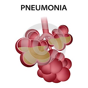 Pneumonia alveoli icon, realistic style