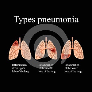 Pneumonia. The anatomical structure of the human lung. Type of pneumonia. Vector illustration on a black background