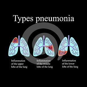 Pneumonia. The anatomical structure of the human lung. Type of pneumonia. Vector illustration on a black background