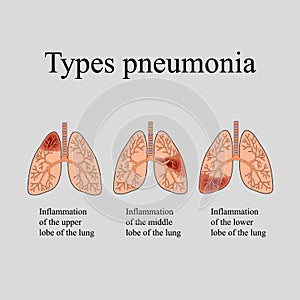 Pneumonia. The anatomical structure of the human lung. Type of pneumonia. Vector illustration on a gray background