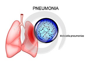Pneumonia. causative agent - Klebsiella photo
